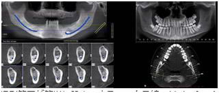 歯科用CTスキャナーについて